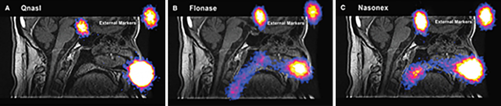 Standard intranasal corticosteroid sprays primarily deposit drug in the anterior and inferior part of the nose. The images on this page come from an open-label, crossover study conducted in nine patients with allergic rhinitis; investigators examined the nasal deposition of radiolabeled materials that allow for traceability following use of QNASL, Flonase, and Nasonex. Gamma cameras were used to capture emitted radiation from these tracers to create two-dimensional images in a process similar to the capture of x-ray images.